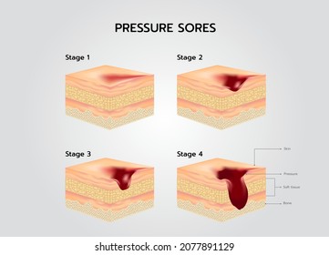 Bedsore Stages Of Pressure Sores Decubitus Ulcer