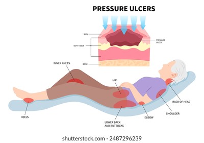 Bedsores pressure ulcer injury skin underlying tissue from lying down or sitting prolonged period time with paralysis patient and immobility adults