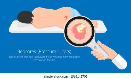 Bedsores (pressure ulcers) injuries skin underlying tissue from lying down or sitting prolonged period time with paralysis patient and immobility adults