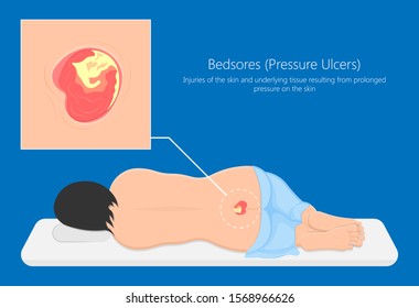 Bedsores (pressure ulcers) injuries skin underlying tissue from lying down or sitting prolonged period time with paralysis patient and immobility adults