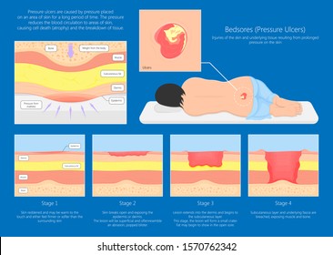 Bedsores (pressure ulcers) injuries skin underlying tissue from lying down or sitting prolonged period time with paralysis patient and immobility adults