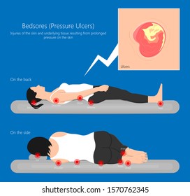 Bedsores (pressure ulcers) injuries skin underlying tissue from lying down or sitting prolonged period time with paralysis patient and immobility adults