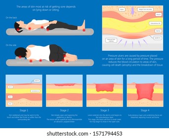 Bedsores (pressure ulcers) injuries skin underlying tissue from lying down or sitting prolonged period time with paralysis patient and immobility adults