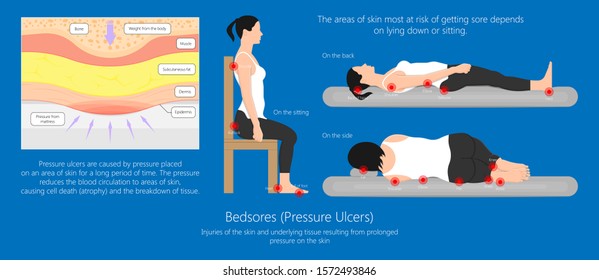 Bedsores (pressure ulcers) injuries skin underlying tissue from lying down or sitting prolonged period time with paralysis patient and immobility adults