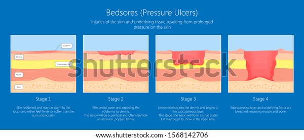 Bedsores Pressure Ulcers Injuries Skin Underlying Stock Vector (Royalty ...