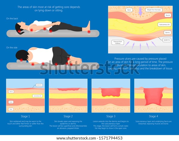 Bedsores (pressure ulcers) injuries\
skin underlying tissue from lying down or sitting prolonged period\
time with paralysis patient and immobility\
adults