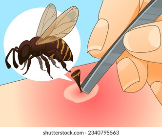 Bee sting. Extract the sting. Injury after a bee sting.  Redness on the skin. Closeup illustration. Healthcare illustration, vector illustration. 