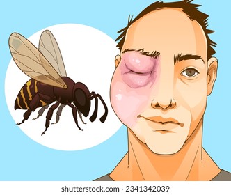 Bee sting. Swollen face. Swollen eye. Injury after a bee sting.  Redness on the skin. Closeup illustration. Healthcare illustration, vector illustration. 