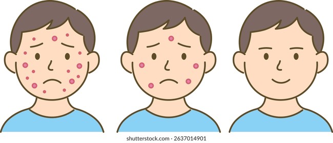 Before and After Acne Improvement – Step-by-Step Illustration
