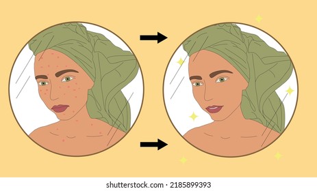 Before After. Acne Skin And Clear Skin. Acne Treatment. Young Woman With A Towel On Her Head. Spa Beauty Salon Illustration. Mirror. Morning Routine.