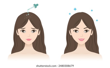 Antes y después de la Ilustración vectorial de tratamiento contra la caspa aislada sobre fondo blanco. La mujer con caspa, escamas secas blancas, cuero cabelludo escamoso y cabello sano. Cuidado del cabello y concepto de problema.