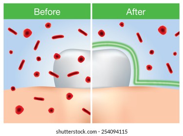 Before and after of bacteria protection around tooth 