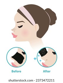 Before and after blackhead pore strip treatment vector illustration isolated on white background. Diagram of woman face with blackhead pore strip on nose, icon set of  how to use removal pore strip.