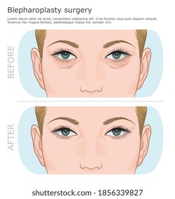 Before and after blepharoplasty surgery. Lower and upper rejuvenation blepharoplasty surgery illustration. Rejuvenating procedure. Wrinkles around the eyes. 