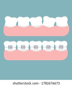 Before And After Braces Vector Illustration. Braces On Teeth Vector.  Crooked Teeth Vector Illustration. Healthy White Teeth Vector Illustration.