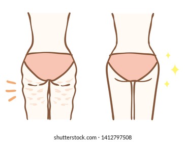 Before And After Cellulite Removal