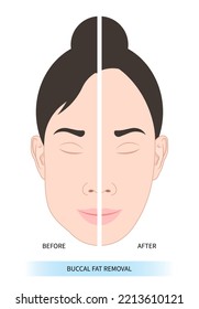 comparar antes y después de la cirugía de eliminación de grasa facial