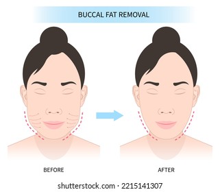 Before and after Cheek buccal fat removal with augment excess slim face of Bichat’s procedure