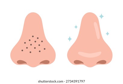 Before and after comparison of a darkened nose with blackheads and a nose that has become beautiful after skin care.