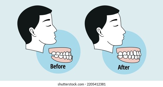 
Before and after dental problem. Side view of man with misaligned teeth. Malocclusion