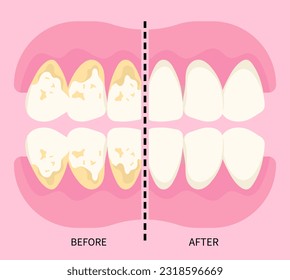 Antes y después de la escala del tartar dental, se compara el concepto en odontología