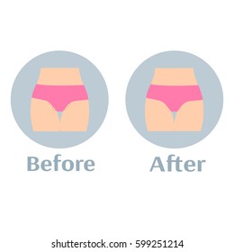 Before and after depilation bikini zone