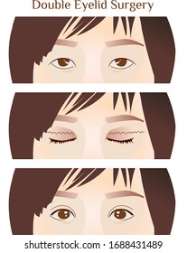 Before and after the double eyelid surgery of Asian women vector illustration