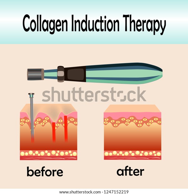 Before after effect, Microneedle stamping device,\
Collagen induction\
therapy