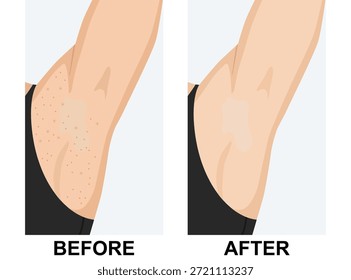 Antes y después del cuidado efectivo de la piel de las axilas. Antes muestra irritación, protuberancias rojas y cabello encarnado, Después muestra piel lisa, limpia y clara
