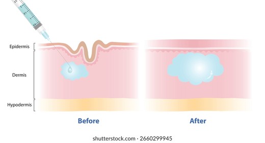 Before and after filler injection under the skin vector illustration on white background. Hyaluronic acid is dermal filler injected to correct the lines and wrinkles. Medical and beauty concept.