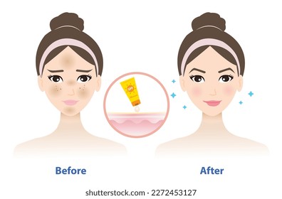 Before and after get used sunscreen vector isolated on white background. Comparison of woman face with melasma and the better result of wearing sunscreen on face. Skin care and beauty concept.