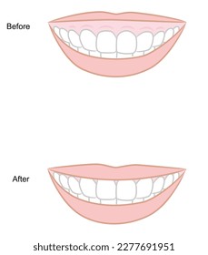 Before and after gummy smile treatment