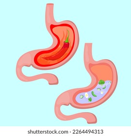 Before and after heartburn treatment. Hot chili pepper as acid indigestion and water with food as healthy condition, stomach illustrations. Gastroesophageal reflux disease