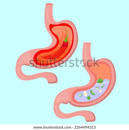 Before and after heartburn treatment. Hot chili pepper as acid indigestion and water with food as healthy condition, stomach illustrations. Gastroesophageal reflux disease
