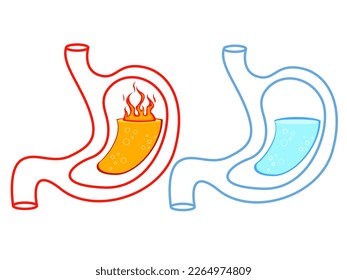 Before and after heartburn treatment. Lava as acid indigestion and water as healthy condition, stomach illustrations on white background. Gastroesophageal reflux disease