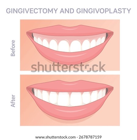 Before and after illustration of gingivectomy and gingivoplasty dental procedure, showing gum contouring and smile improvement.
