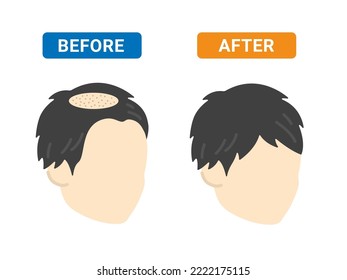 A before and after illustration of a man who received AGA treatment.