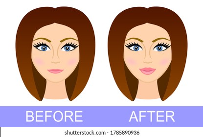 Before after lip correction. Woman after using lip filler. Lip Augmentation. Before and after lip filler injections. Hyaluronic Acid injections. Vector illustration. Poster. Banner. Plastic surgery