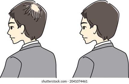 Before and after men with thin hair.