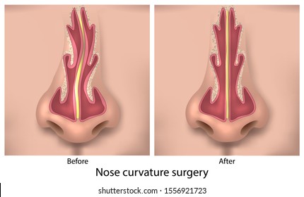 Before and after nasal curvature surgery