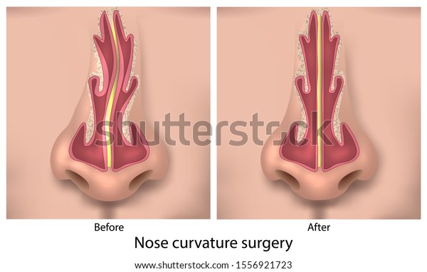 Before After Nasal Curvature Surgery Stock Vector (Royalty Free) 1556921723