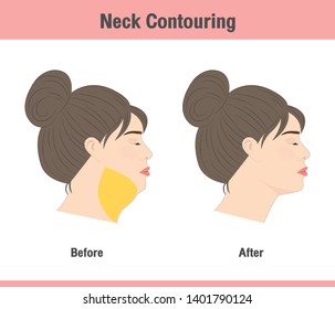 Before and after of neck contouring to remove unwanted fat with brown hair woman
