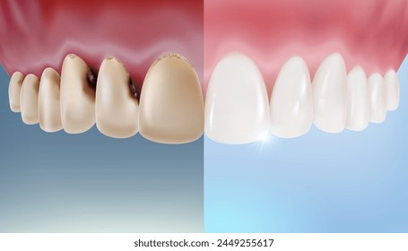 Fotos de antes y después de dientes de descamación y blanqueamiento o coronas artificiales. Concepto de tratamiento oral y cirugía de blanqueamiento dental. Clínica de conductos, pasta dental, enjuague bucal. archivo de Vector.