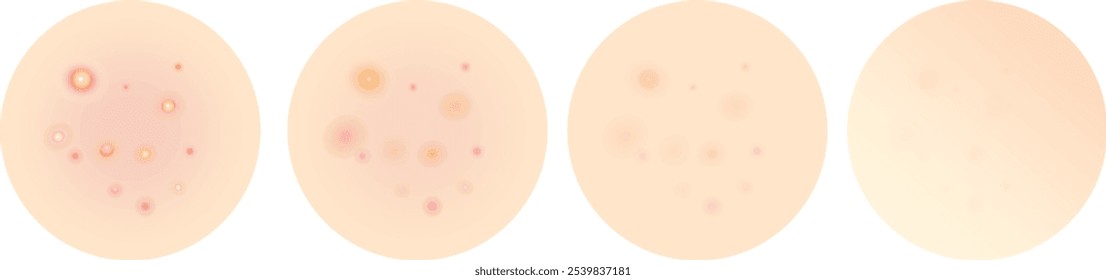 Antes y después de las espinillas, el acné aislado de fondo, problema de cuidado de la piel, el progreso usando crema para el acné, tratamiento	
