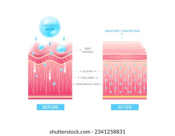 Before and after process of getting skin younger with help of moisturizer collagen. Hyaluronic acid serum drop blue absorbed into the skin cell. Solution for cosmetic advertising. 3D Vector EPS10.