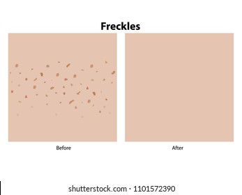 Before and After Removal Freckles on Skin Vector Illustration