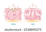 Before and after the skincare rejuvenate collagen and elastin in dermis vector illustration on white background. Cross section of wrinkles skin and skincare absorbing to help restore aging skin.