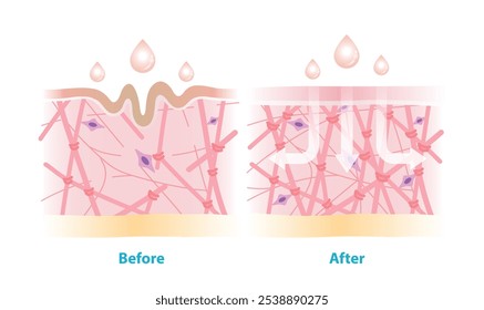 Antes e depois do cuidado da pele rejuvenescem o colágeno e a elastina na ilustração do vetor da derme sobre fundo branco. Seção transversal de rugas e absorção de cuidados da pele para ajudar a restaurar a pele envelhecida.