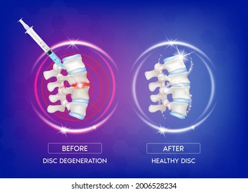 Before And After Spinal Treatment With Syringe Needle To Degenerative Disc And Herniated Disc, Normal Backbone. Skeleton X Ray Scan Concept. Human Vertebrae Anatomy Medical. 3D Vector.