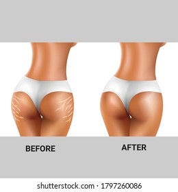 Antes y después de las marcas de estiramiento en las nalgas de la mujer para el concepto de salud